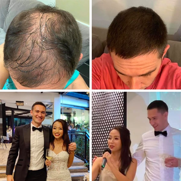 Adegen reviews | Hair growth before and after of a man on his wedding day