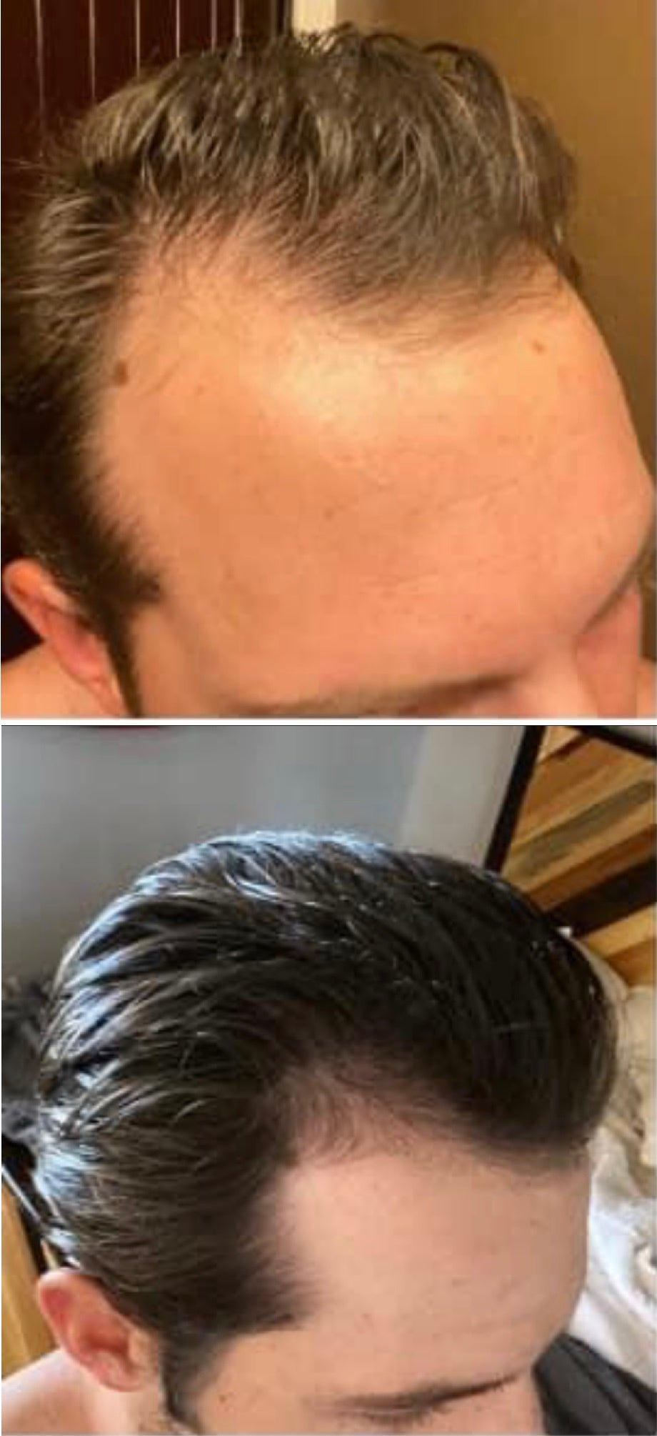 Adegen reviews | Hair growth before and after of a man with hair thinning on his crown and temples