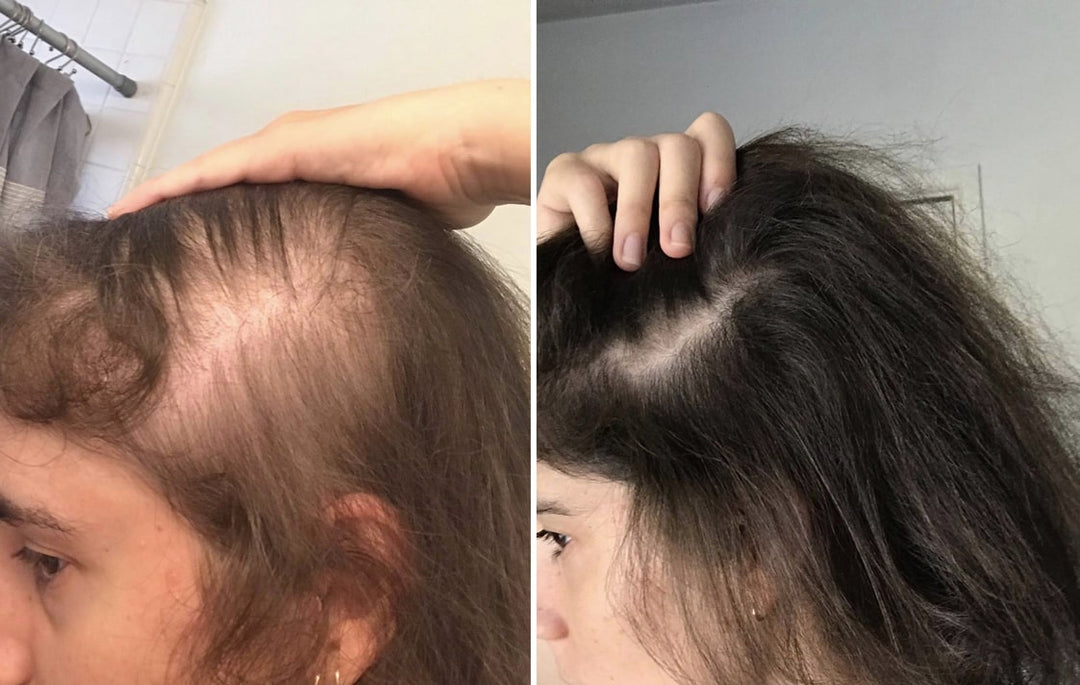 Adegen reviews | Hair growth before and after of a young woman