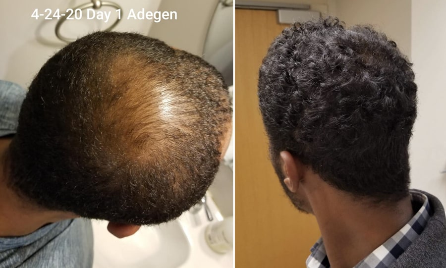 Adegen reviews | Hair growth before and after of a man with hair thinning on the top of his head