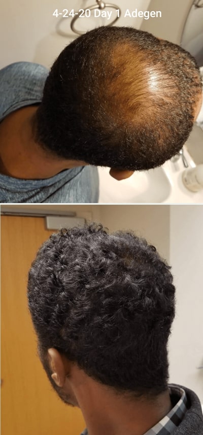 Adegen reviews | Hair growth before and after of a man with hair thinning on the top of his head