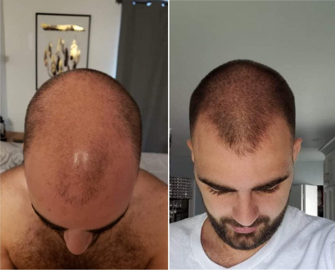 Adegen reviews | Hair growth before and after of a man who was balding on his crown