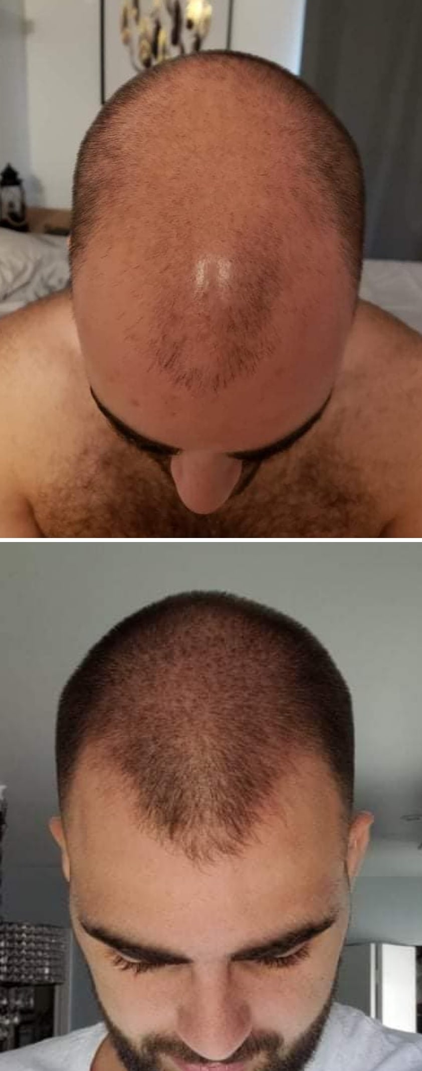 Adegen reviews | Hair growth before and after of a man who was balding on his crown