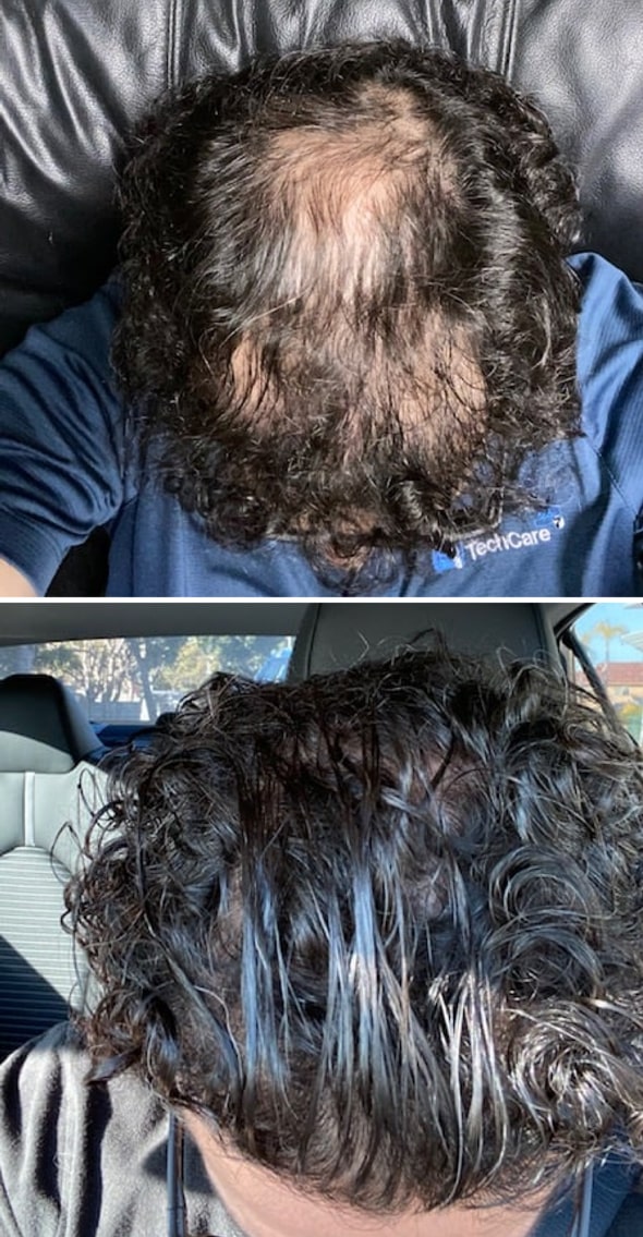 Adegen reviews | Hair growth before and after of a man with hair thinning on the top of his head