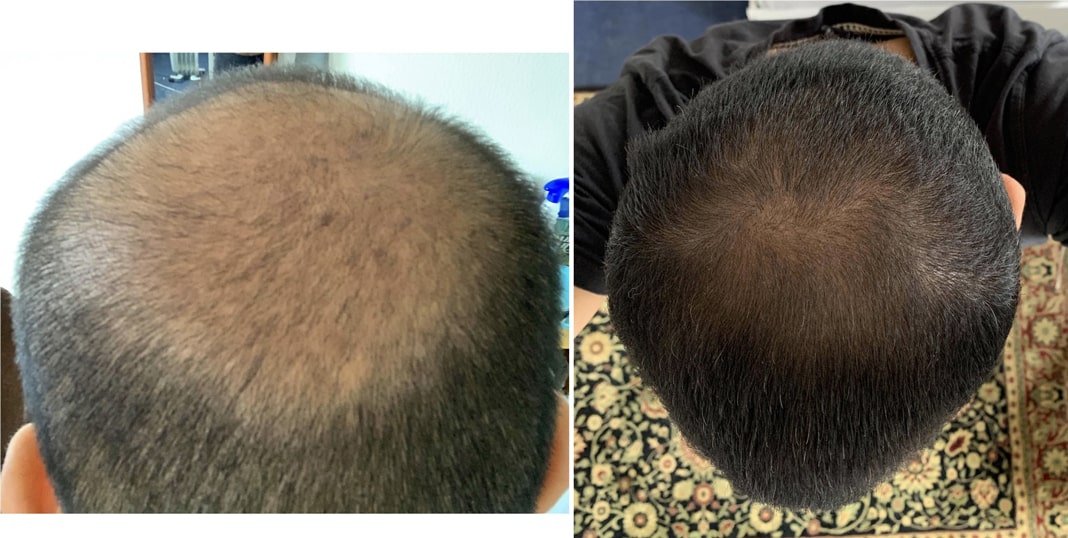 Adegen reviews | Hair growth before and after of the top of a man's head