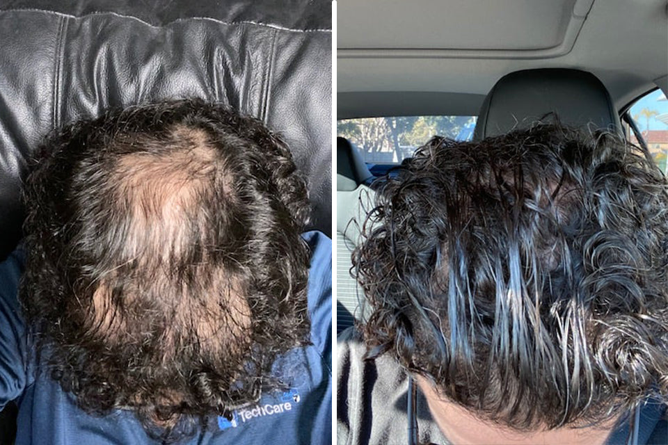 Adegen reviews | Hair growth before and after of a man with hair thinning on the top of his head