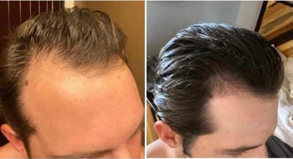 Adegen reviews | Hair growth before and after of a man with hair thinning on his crown and temples