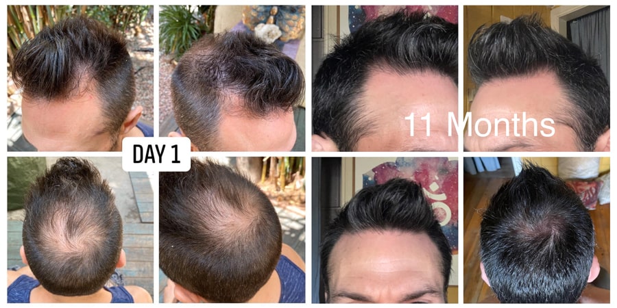 Adegen reviews | Hair growth before and after of a man after using Adegen hair regrowth kits for 11 months