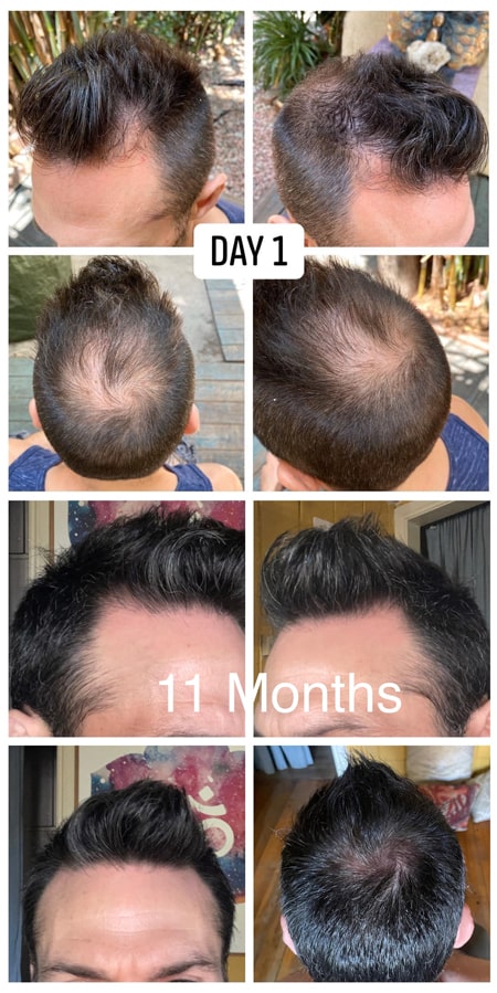 Adegen reviews | Hair growth before and after of a man after using Adegen hair regrowth kits for 11 months