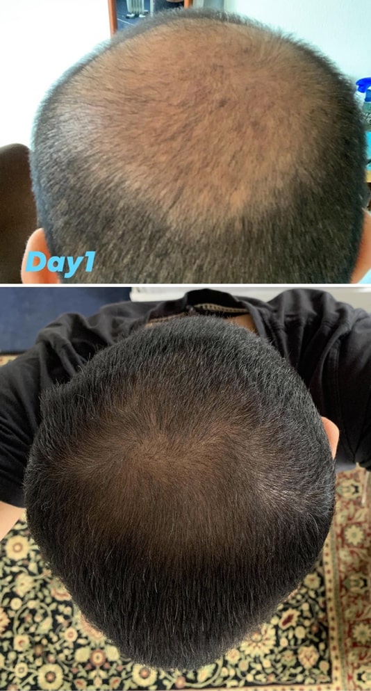 Adegen reviews | Hair growth before and after of the top of a man's head