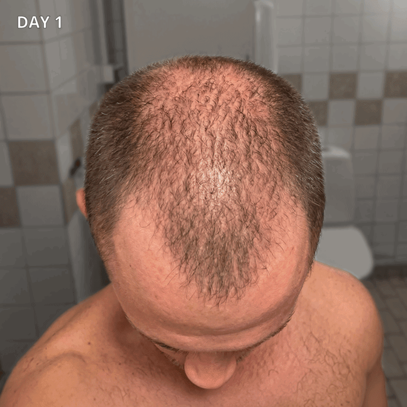mans hair growth with adegen
