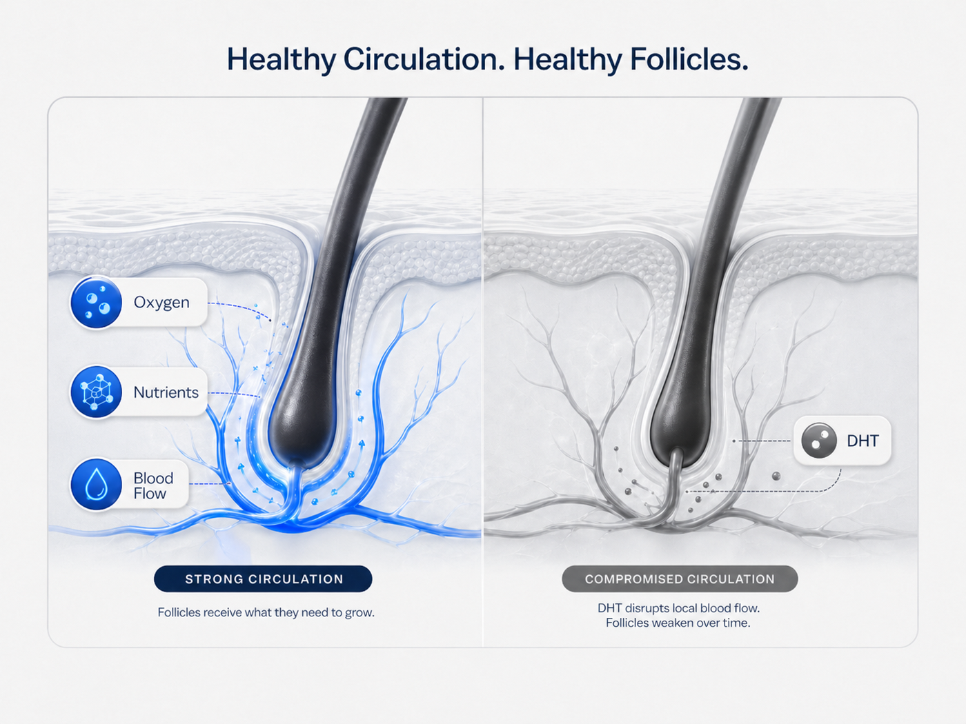 Comparison diagram: follicles with strong circulation receive oxygen, nutrients, and blood flow; DHT disrupts circulation and follicles weaken