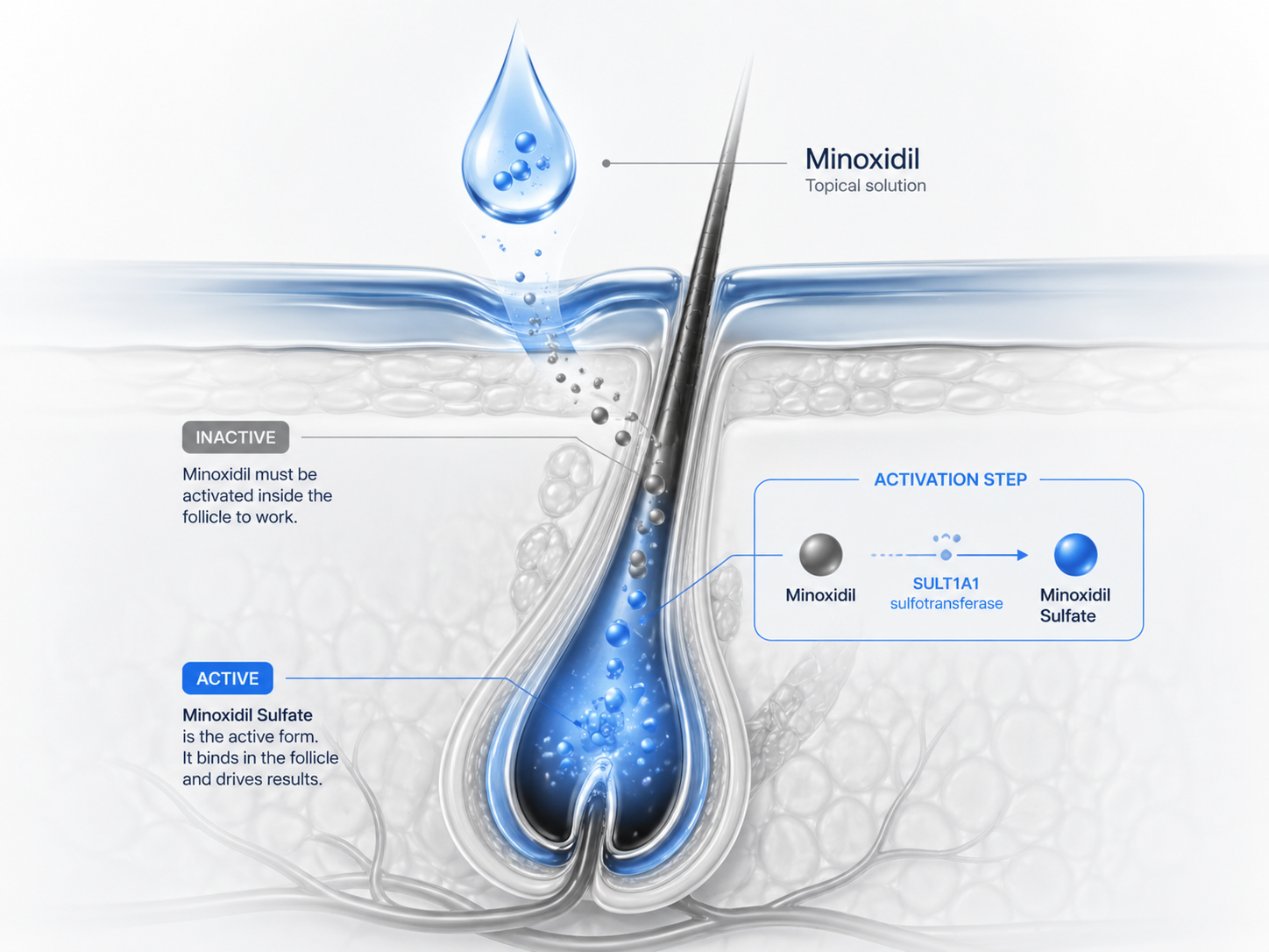 Diagram: minoxidil lands on the scalp inactive and must be converted to minoxidil sulfate by the SULT1A1 enzyme inside the follicle