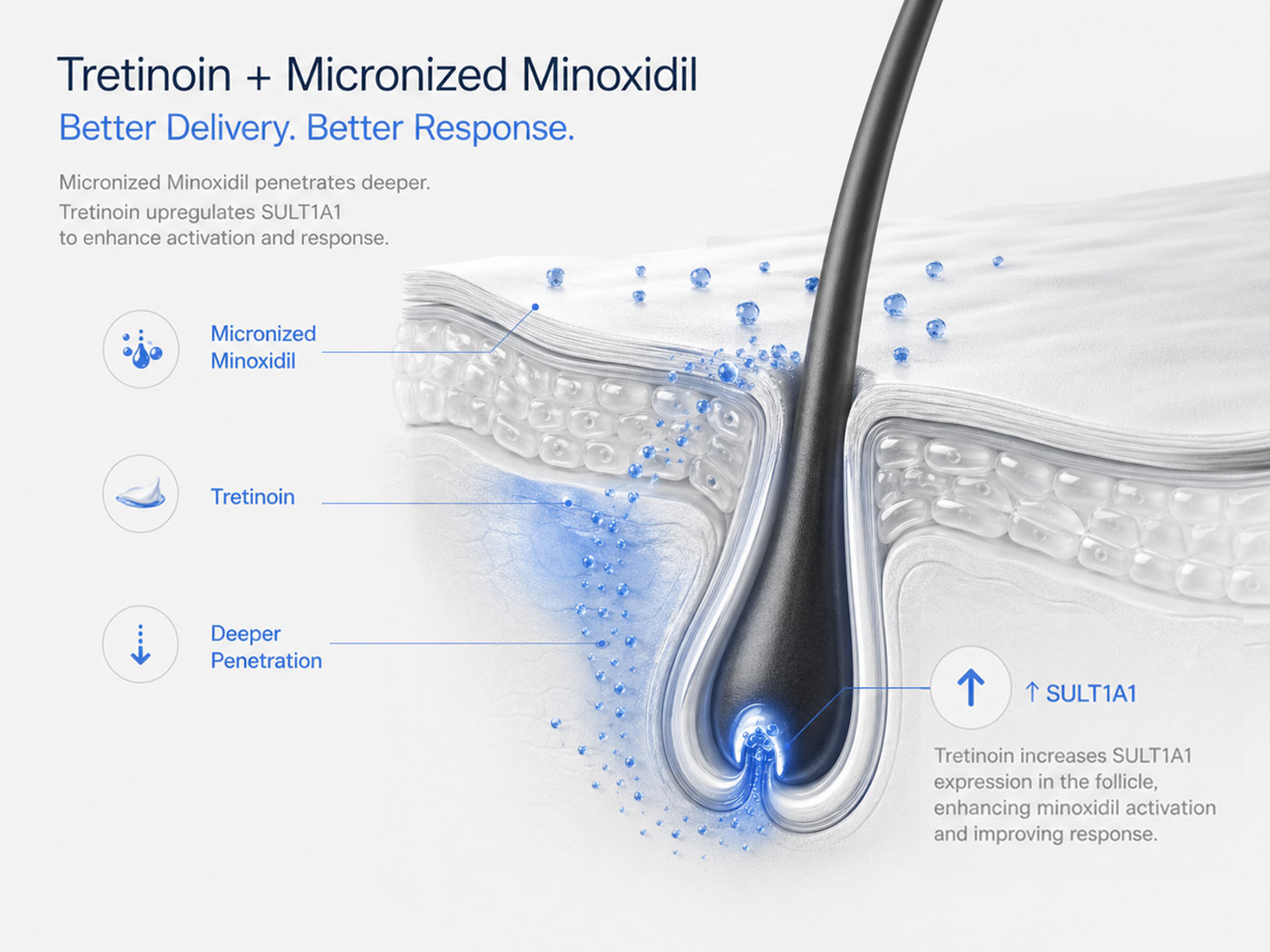 Diagram: micronized minoxidil penetrates deeper while tretinoin upregulates SULT1A1 in the follicle, enhancing activation and response